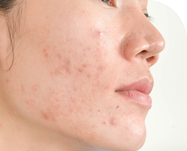 acne-causes-signs-symptoms