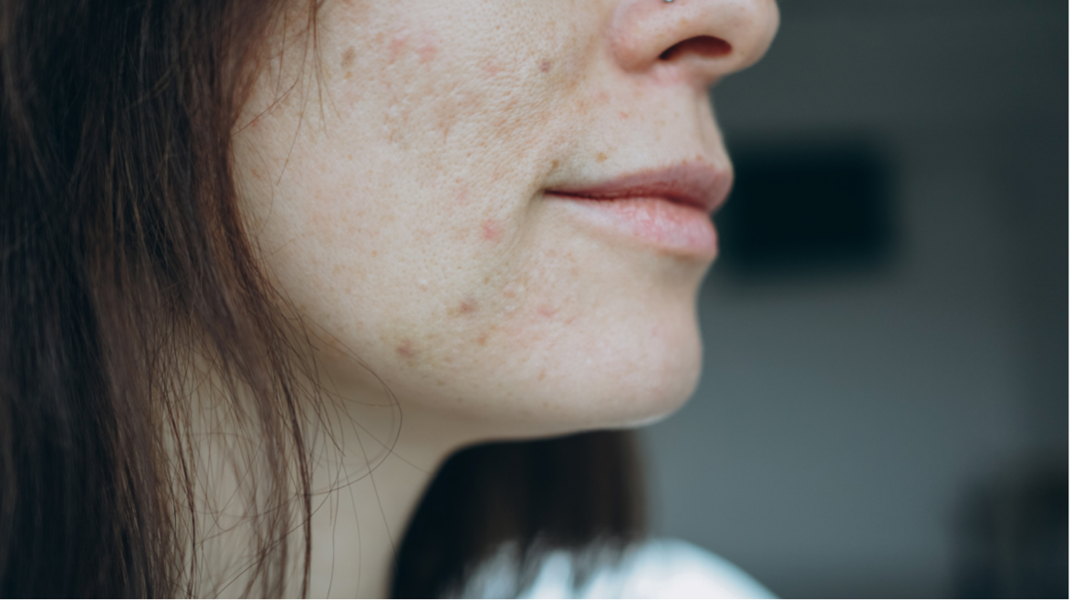 What Are the 3 Common Causes of Acne Breakouts with Adults?